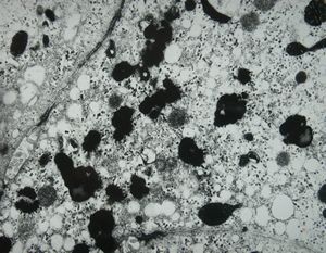 M,15y. | Wilson disease M,15y. | Wilson disease